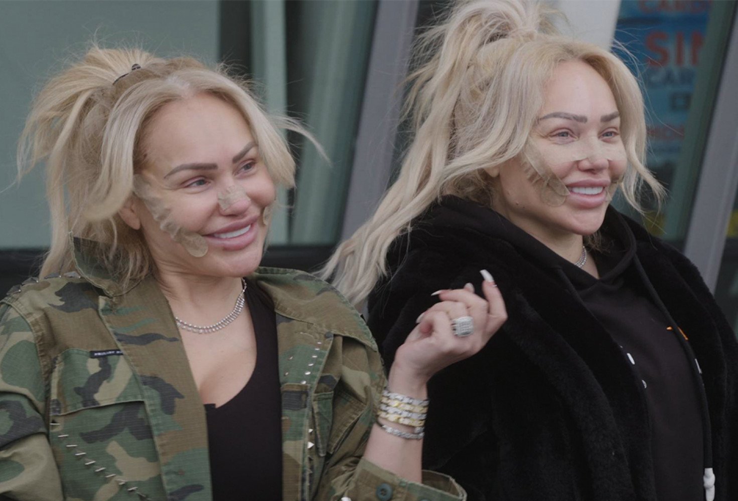 Darcey and Stacey Silva smiling together with facial bandages after their Turkey makeover